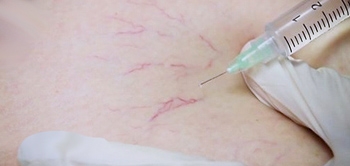 Köpükle Varis Tedavisi