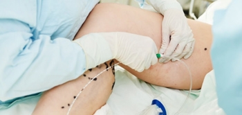 Lazerle Varis Tedavisi